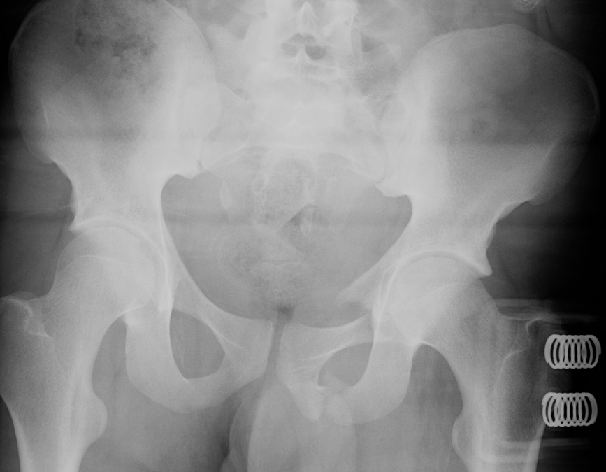 Pelvic Lateral Compression Fracture LC1